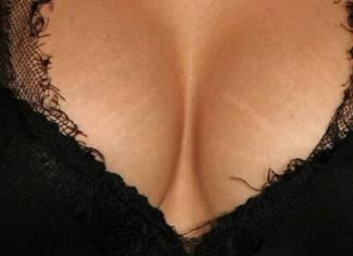 Što uzrokuje i kako se riješiti strija na prsima?
